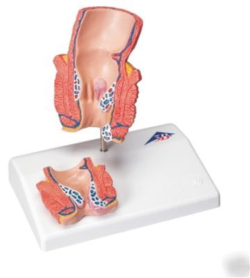 3B scientific hemorrhoid digestive anatomical model