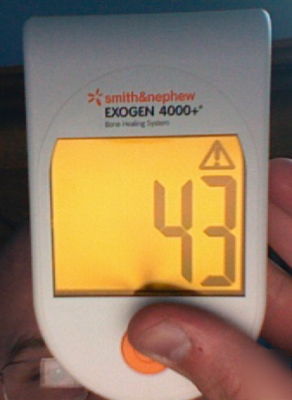 Exogen 4000+: bone stimulator healing system
