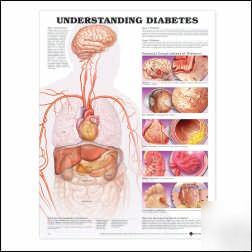 Understanding diabetes anatomical chart/charts/model